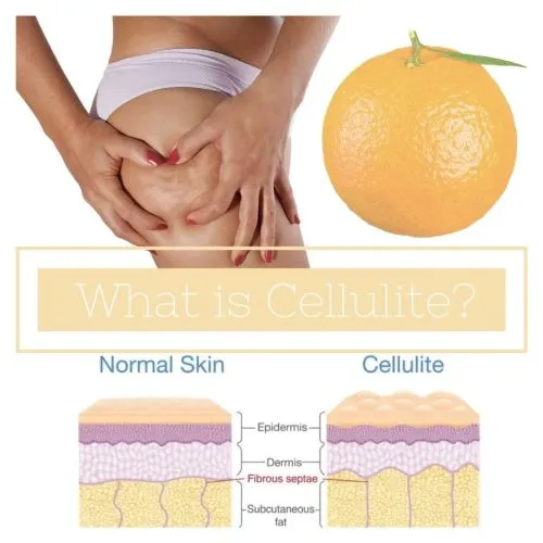 Cellulite
