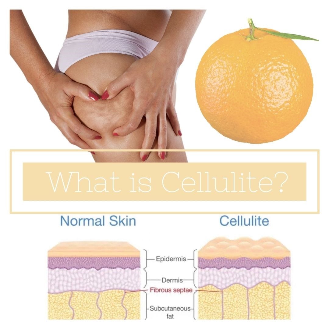 Cellulite removal in Chorley