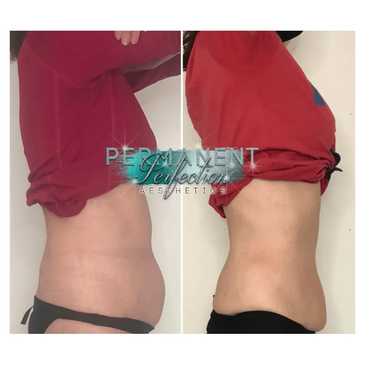 3D Lipo Ultimate Pro