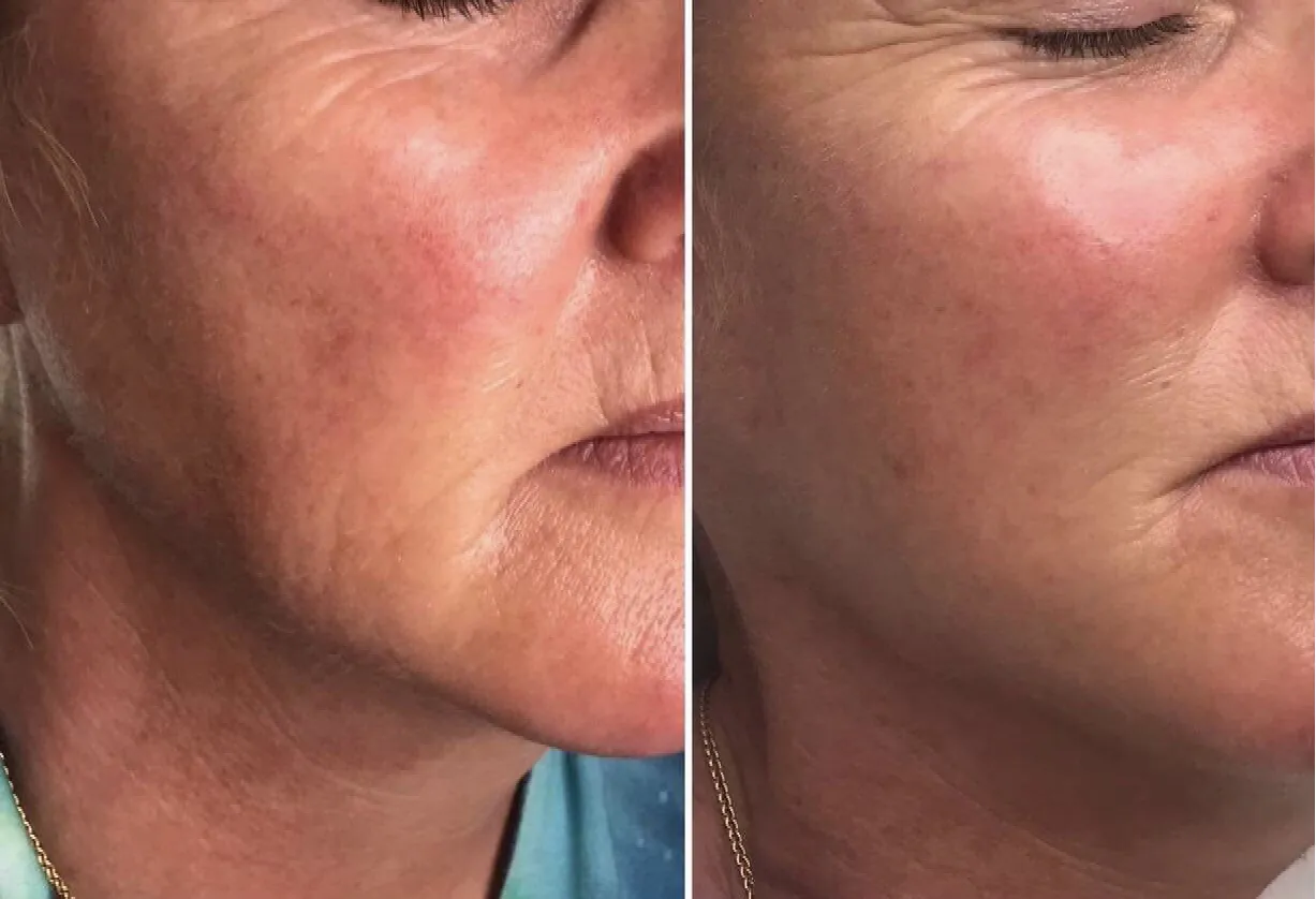 3D HIFU Non-Surgical Facelift