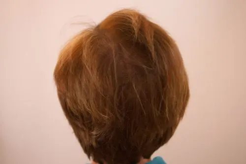 Female Scalp Micropigmentation: Enhance your confidence