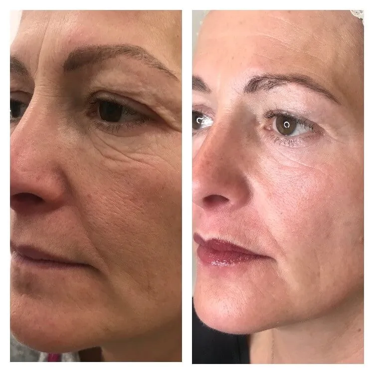 3D HIFU Facelift