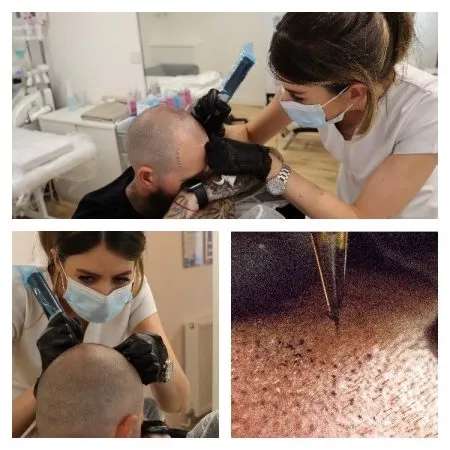 Hair Transplant vs Scalp Micropigmentation