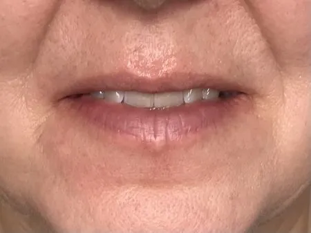 Thinning Lip Treatment