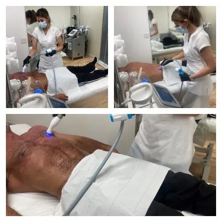 Radio Frequency Skin Tightening