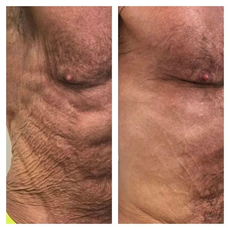 Stomach Skin Tightening in Wigan