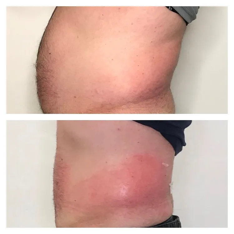 3D Radio Frequency Fat Melting