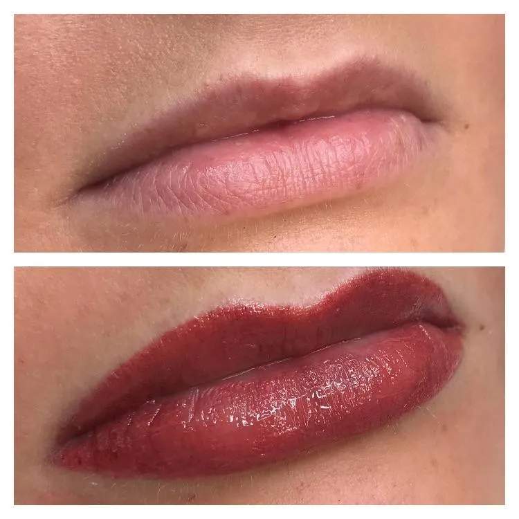 Thinning Lips Treatment