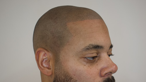After Micropigmentation