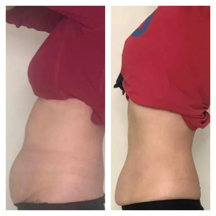 Body Contouring Reviews
