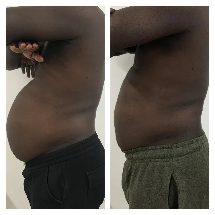 Belly Fat Removal Cavitation