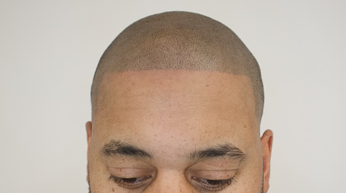 Hair Micropigmentation After