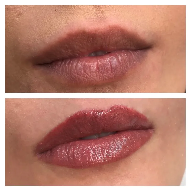 Thinning Lips Treatment