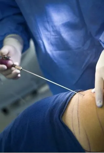 Invasive Body Contouring