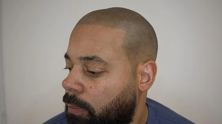 Scalp Micropigmentation