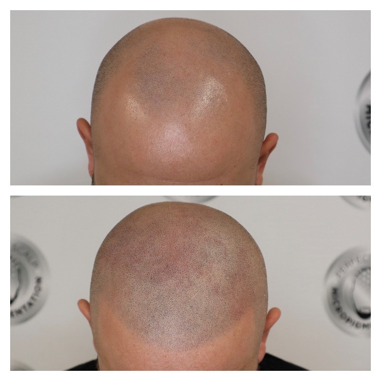 Scalp Micropigmentation Hairline Tattoo, What You Need To Know