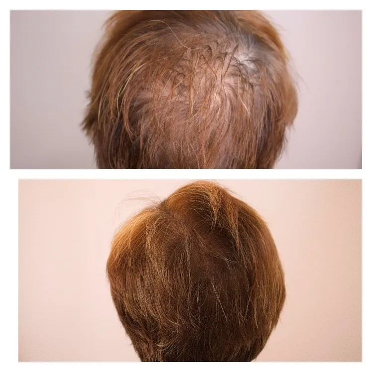 Female Scalp Micropigmentation