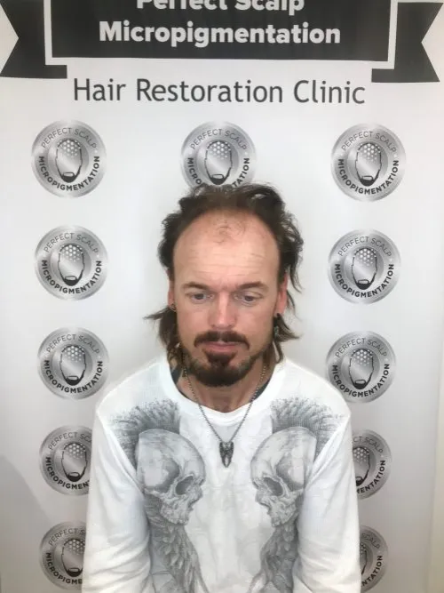 Hair Loss
