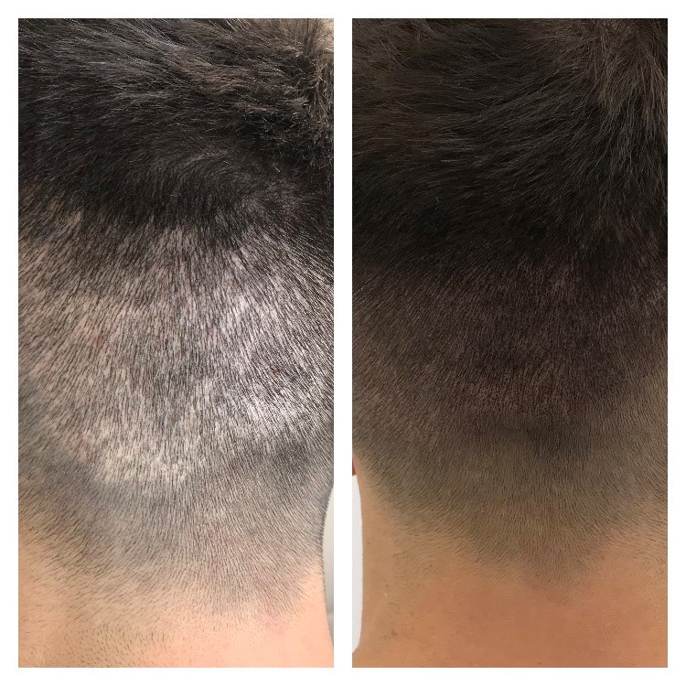 Scalp Micropigmentaion Before and After