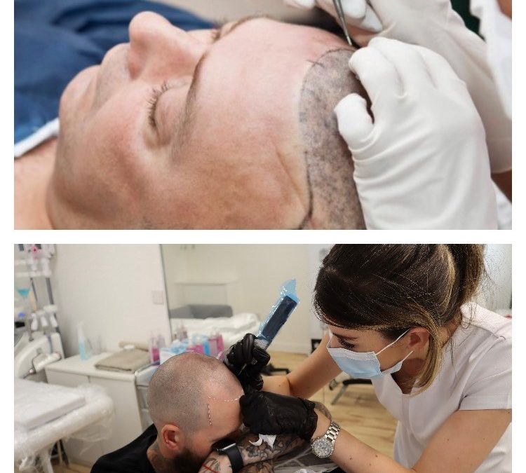Hair Transplant vs SMP - Which Is Best For You?