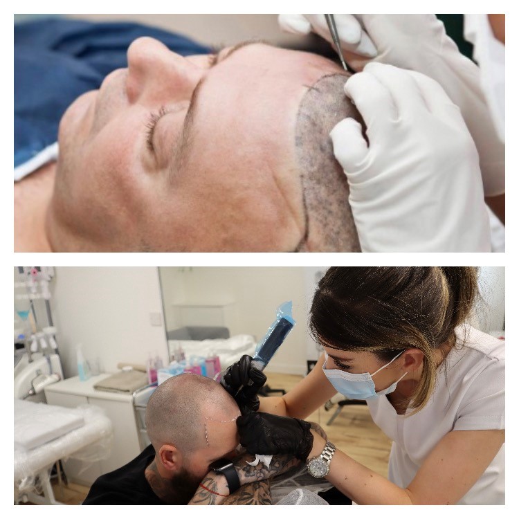 Hair Transplant vs SMP - Which Is Best For You?