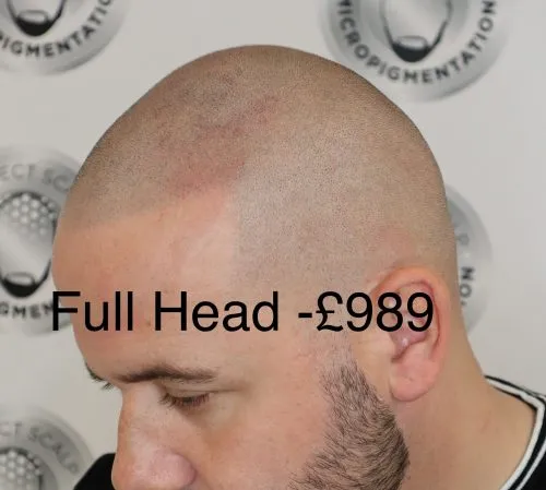 How Much Does Scalp Micropigmentation Cost