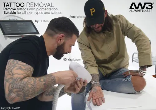 Tattoo Removal Methods