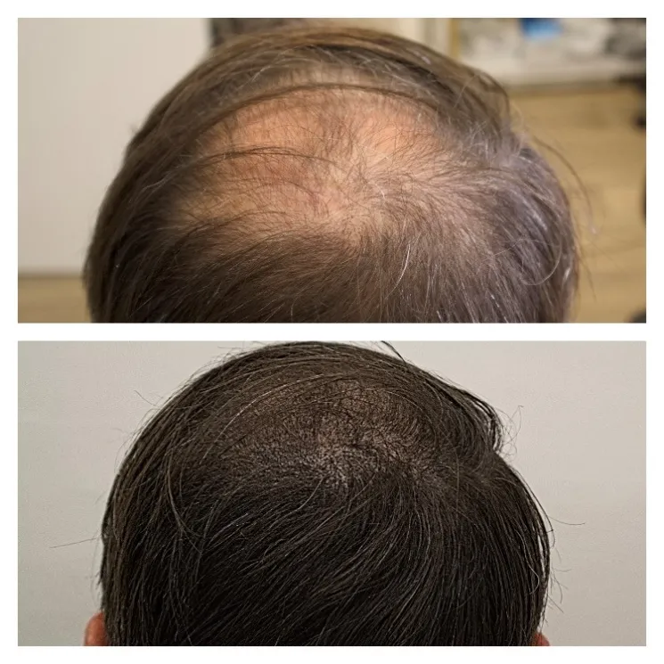 SMP vs Hair Transplant