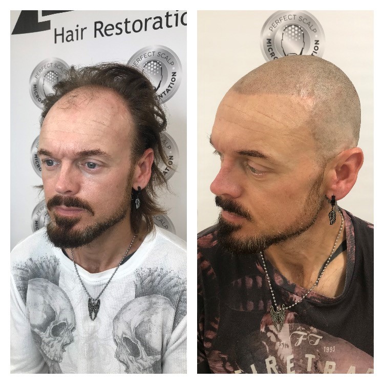 Scalp Micropigmentation Before And After