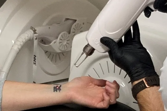 Wigan Laser Tattoo Removal