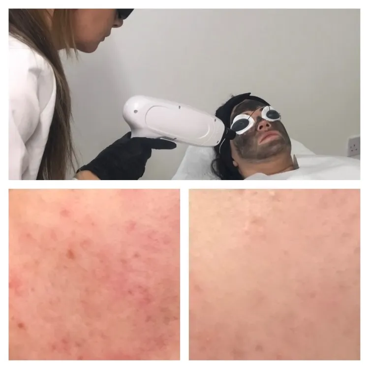 Carbon Laser Facial In Wigan