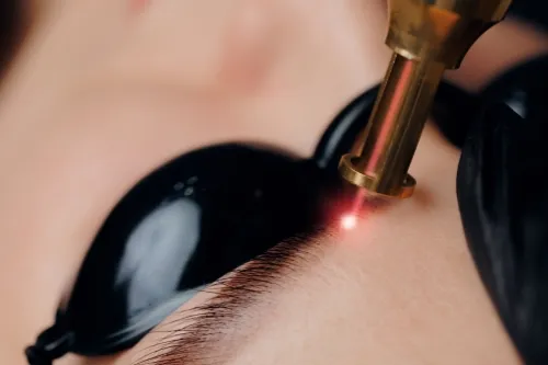 Eyebrow Tattoo Removal Wigan