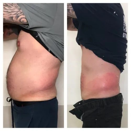 Fat Freezing In Wigan