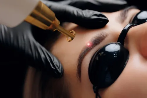 Laser Eyebrow Removal