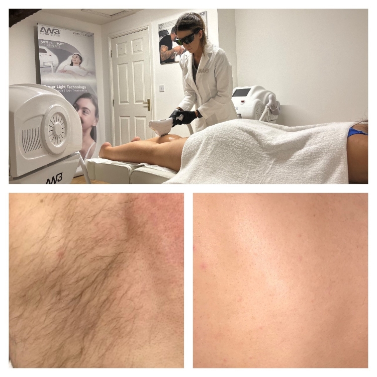 Laser Hair Removal In Wigan