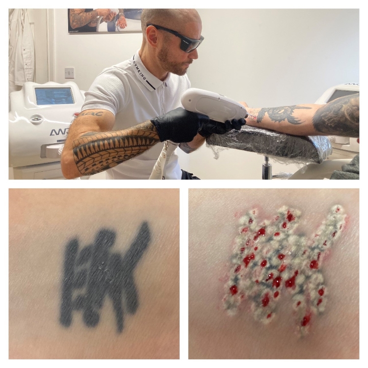 Laser Tattoo Removal In Wigan