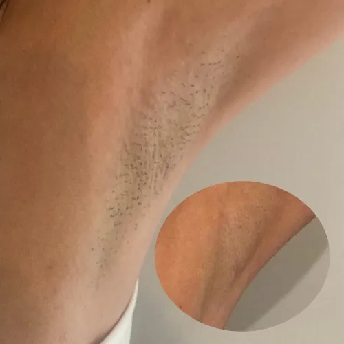 Laser Hair vs. Shaving