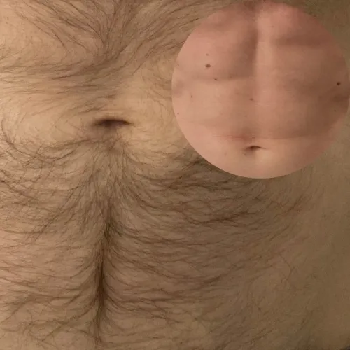 Laser Hair Removal For Men