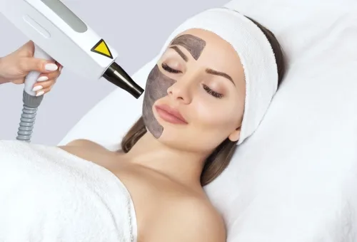 Carbon Laser Facial FAQ’s: All You Need to Know For Perfect Skin