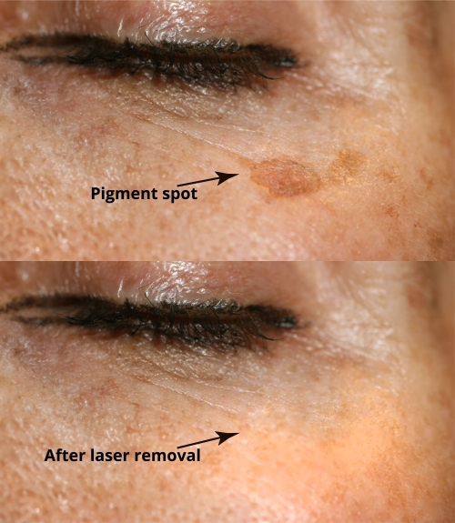 Laser Sun Spot Removal Before and After