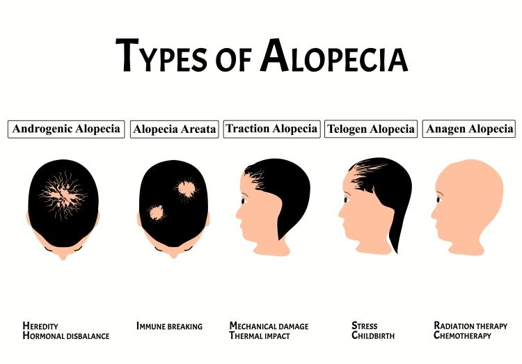 Alopecia Explanation