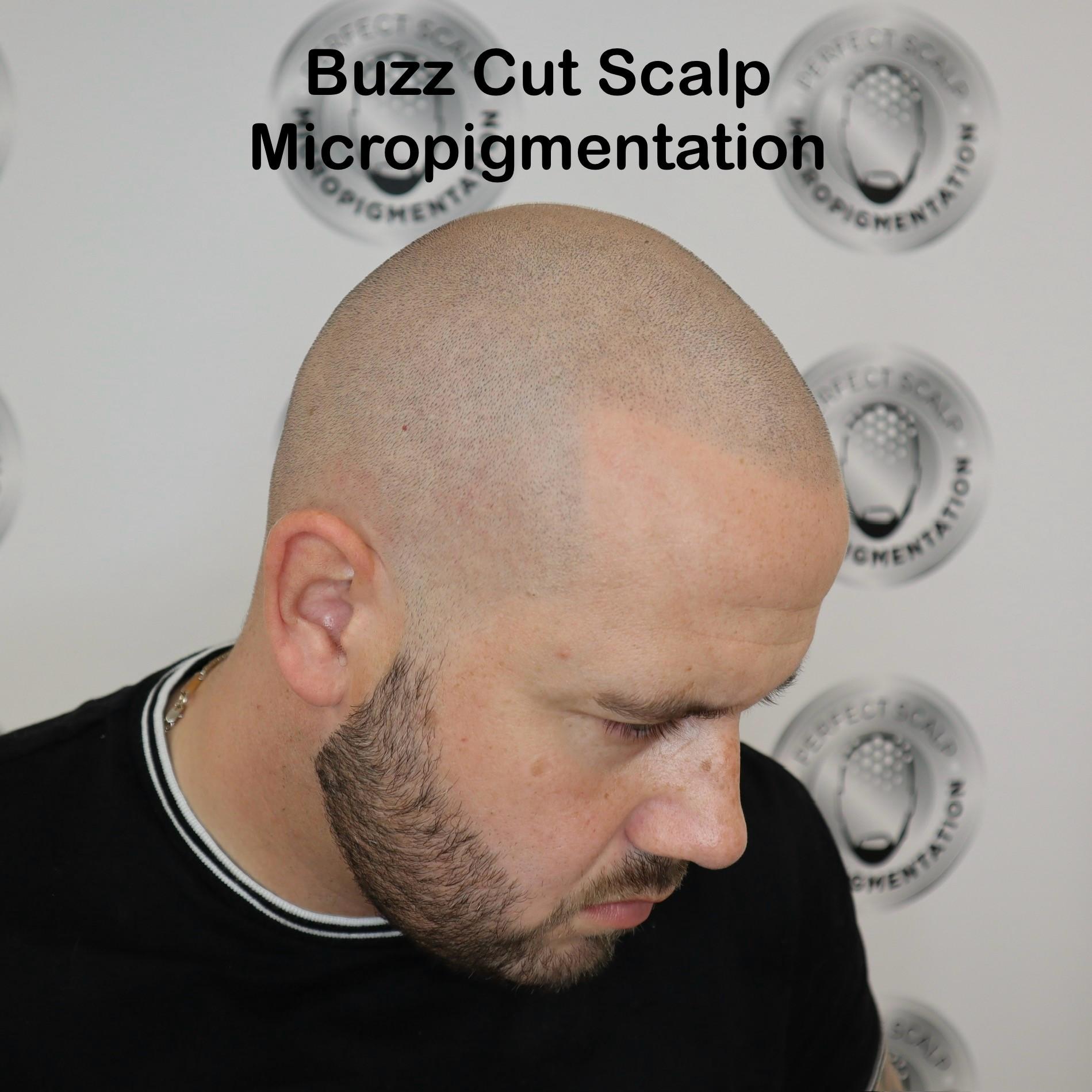 Buzz Cut Scalp Micropigmentation