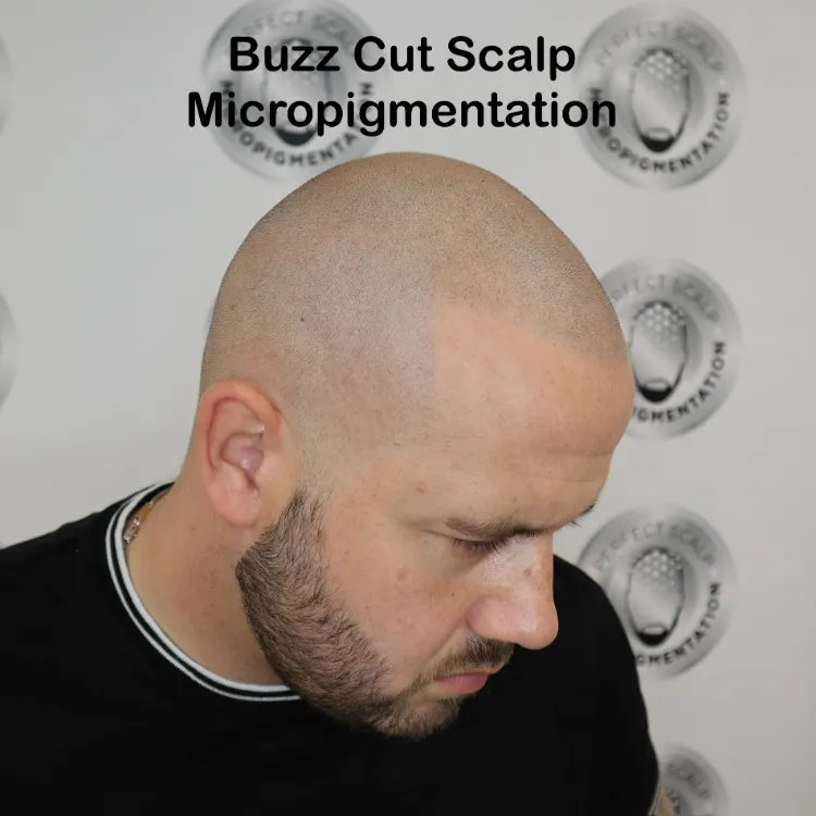 Buzz Cut Scalp Micropigmentation