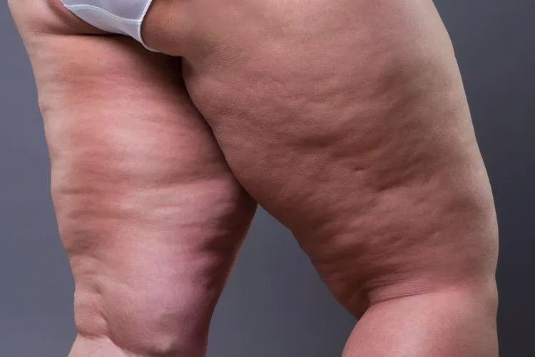Cellulite On Leg