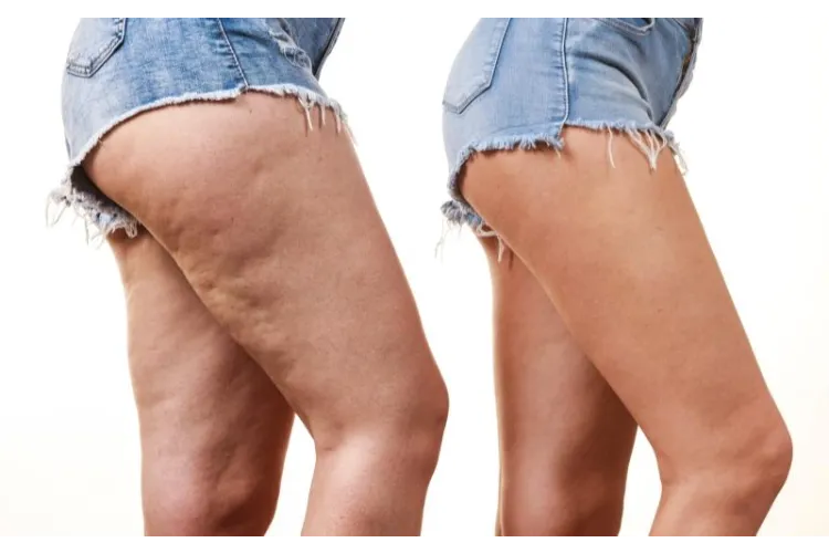 Cellulite Reduction With Exercise