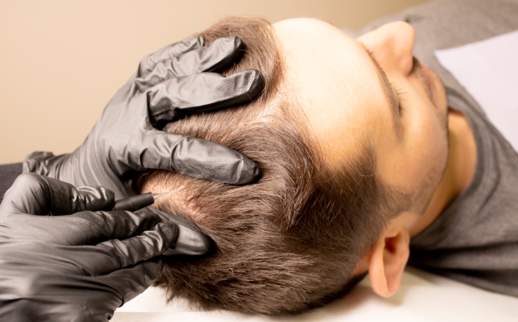 Density Scalp Micropigmentation: The Ultimate Solution for Thicker Looking Hair