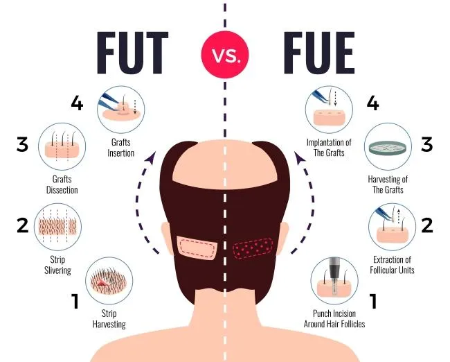 Hair Transplant Fut vs Fue