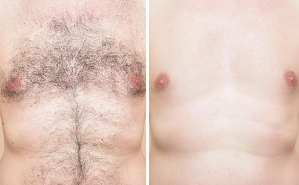 Mens Body Hair Removal - Chest