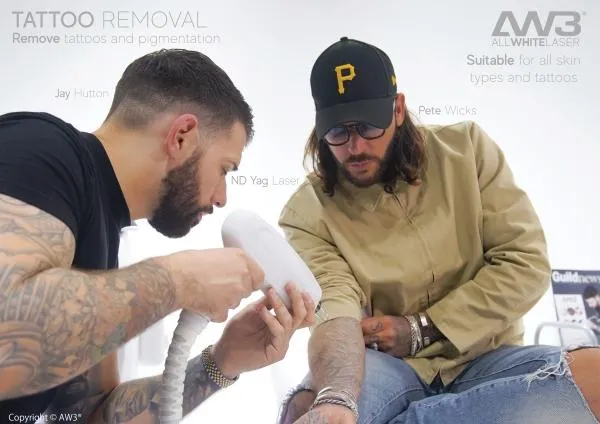 Laser Tattoo Removal vs Dermabrasion