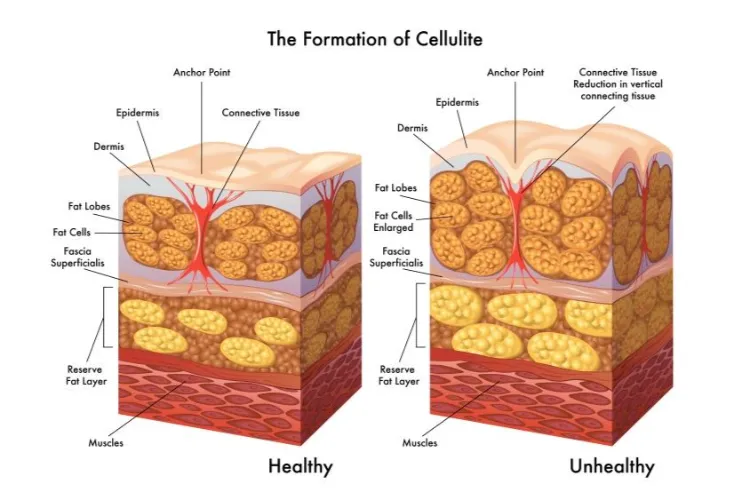 What Is Cellulite